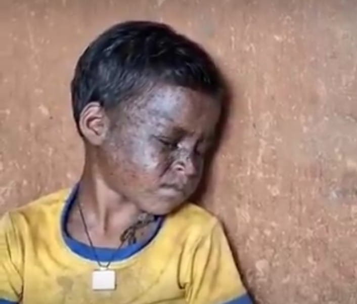 Jamshedpur: पोटका की सोनामनी सबर को सूरज की रोशनी से घबराहट, अंधेरे में रहने को है विवश, इस दुर्लभ बीमारी को लेकर सीएम ने दिया निर्देश